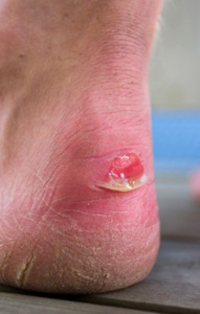 What Causes Blisters