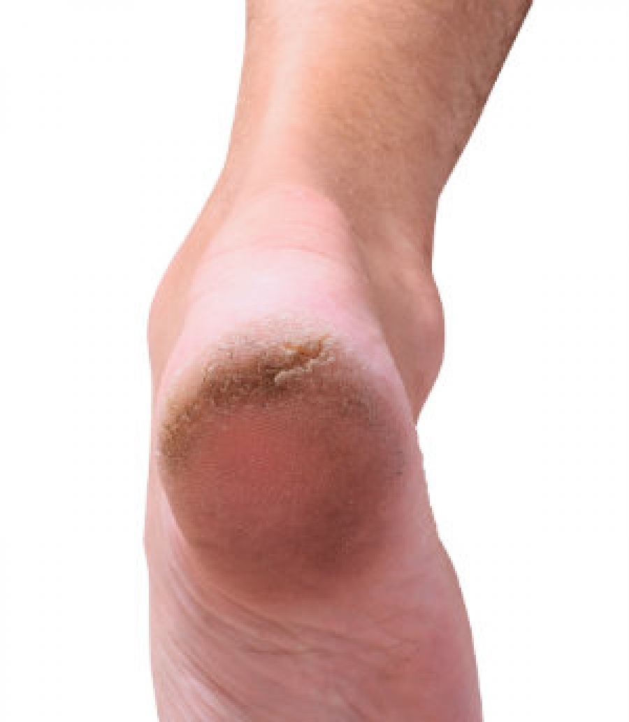 What Causes Cracked Heels? 3 Potential Causes + Treatment
